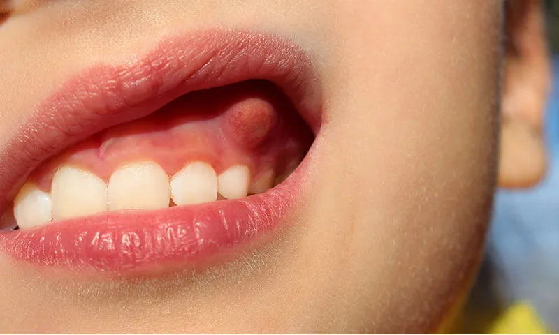 How to combat dental fistulas?